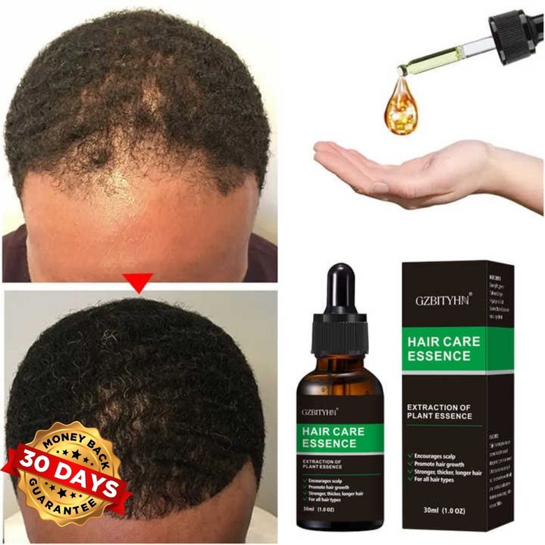 Aceite para el crecimiento del cabello - ¡Rellena de forma natural las calvas en 10 días!